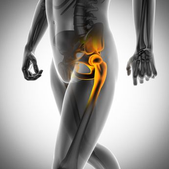hip replacement