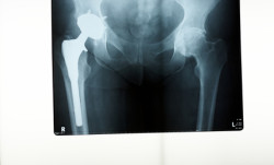 A x-ray of a hip replacement