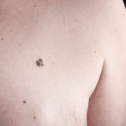 viagra-melanoma-skin