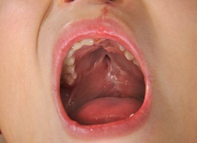 depakote-cleft-palate