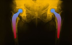 hip-implant-image