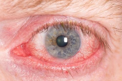 eye pain