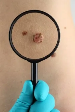viagra-melanoma-mole