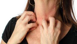 SJS-skin-rash-itch