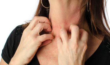 SJS-skin-rash-itch