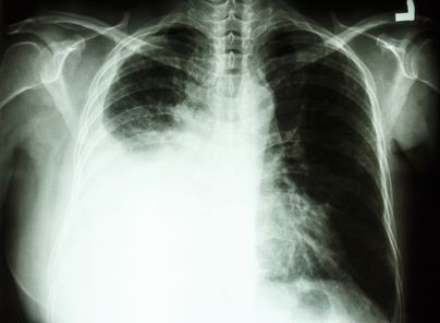 aasbestos-mesothelioma-xray