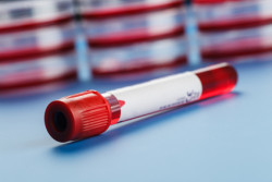 Blood sample in a test tube Vacutainer