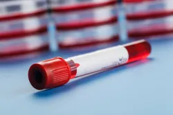 Blood sample in a test tube Vacutainer