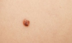 melanoma-skin-viagra