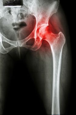 Arthritis at hip joint ( X-ray pelvis & hip joint ) , ( Gout , Rheumatoid )