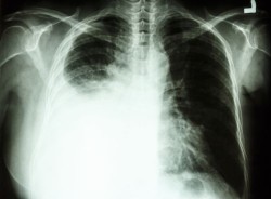 lung-cancer-congress