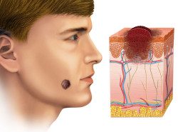viagra melanoma skin cancer