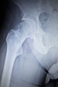 metal-hip-implant