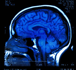 Magnetic resonance image (MRI) of the brain