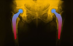 hip-implant-lawsuit