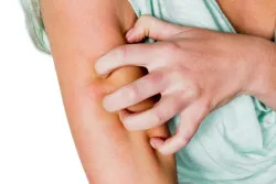 a woman has after a mosquito bite an itchy skin and scratching
