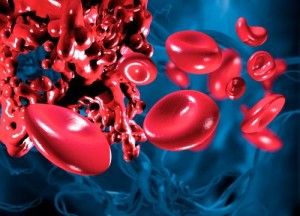 ivc-blood-clot