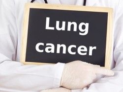 Doctor shows information on blackboard: lung cancer