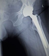 hip-replacement-lawsuit