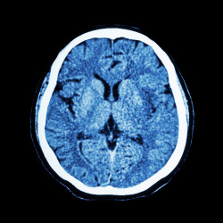 brain scan dilantin cerebral atrophy