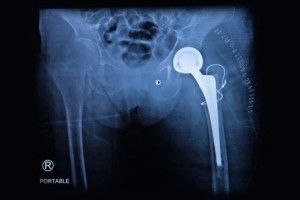 depuy-hip-lawsuit