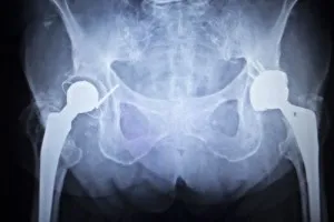 metal-hip-lawsuit
