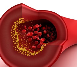IVC-filter-vein2