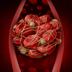 Blood Clot IVC Filter