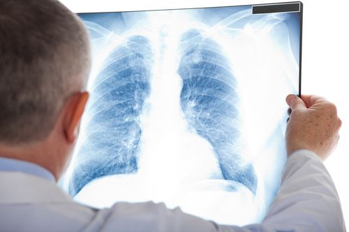 ivc-filter-lung