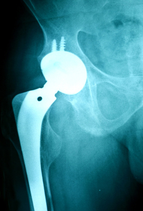 LawsuitLogosPics_hipimplant_iStock_hip-implant-xray