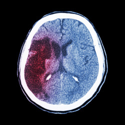 Pradaxa accused of causing brain bleed