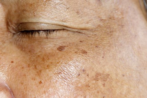 Viagra melanoma cancer lawsuit