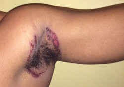 picture of Old Spice chemical burn in user's armpit.
