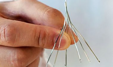 Blood Clot Filter Removal