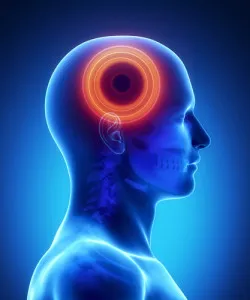 Dilantin Cerebral Atrophy