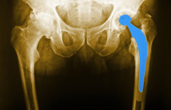 Metal on Metal Hip Implant