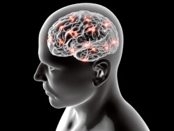 Dilantin Cerebellar Atrophy