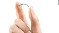 Essure Birth Control