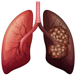 Asbestos Lung Damage