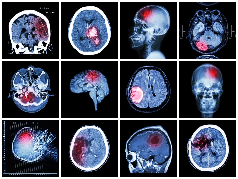 Pradaxa-Intracranial-Hemorrhage