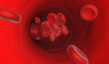 IVC-filter-blood-clot