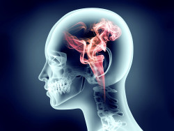 Dilantin Cerebellar Atrophy