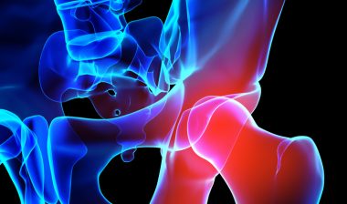 DePuy-ASR-hip-replacement-settlement