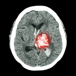 Pradaxa Cerebral Hemorraghing