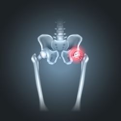 hip implant