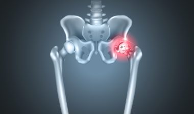 hip implant