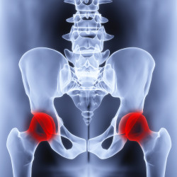 Hip Replacement Lawsuit
