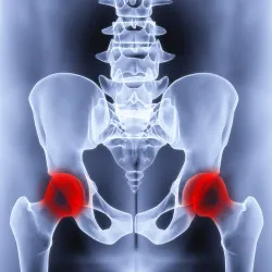 Hip Replacement Lawsuit