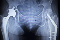 Stryker Metal Hip