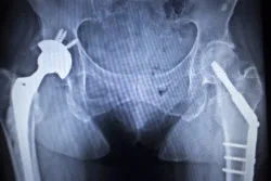 Stryker Metal Hip